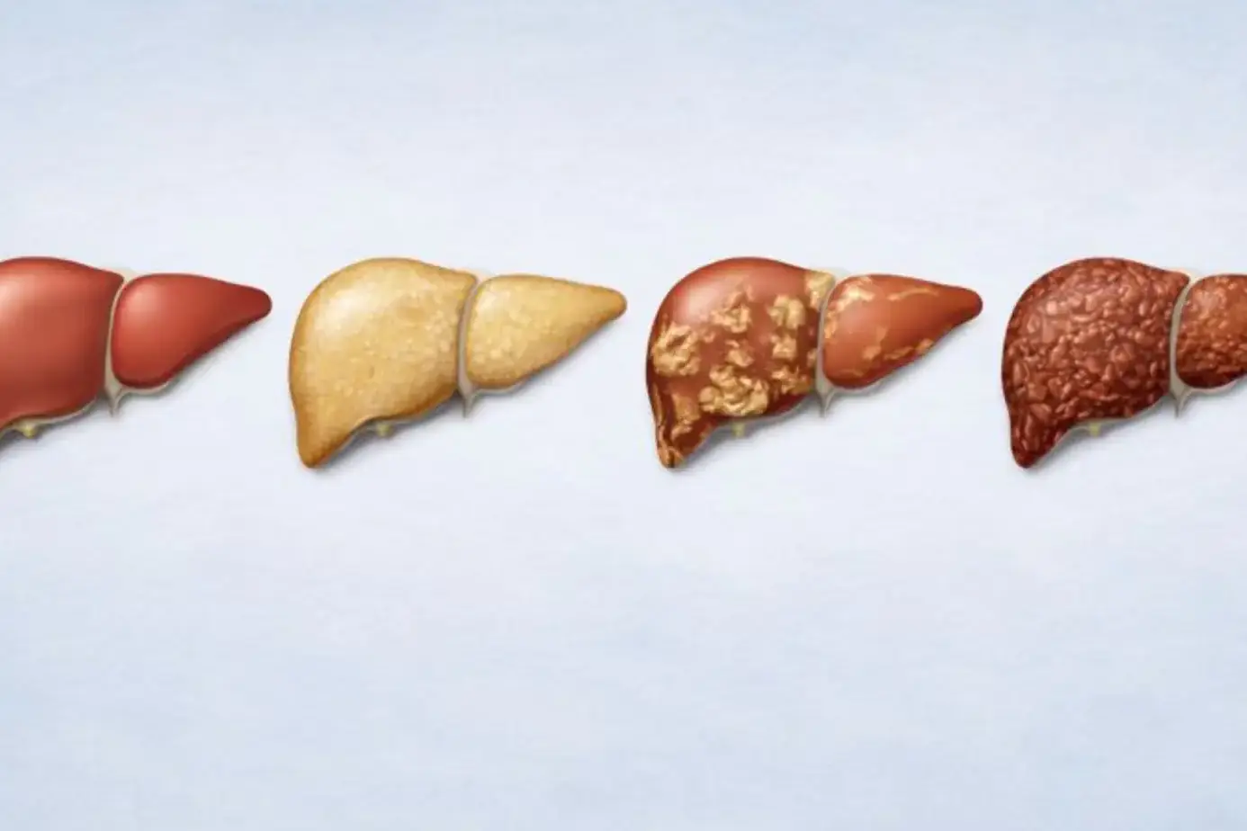 Stages of Liver Disease: Stages, Symptoms, and Treatment 3 Stages of Liver Disease