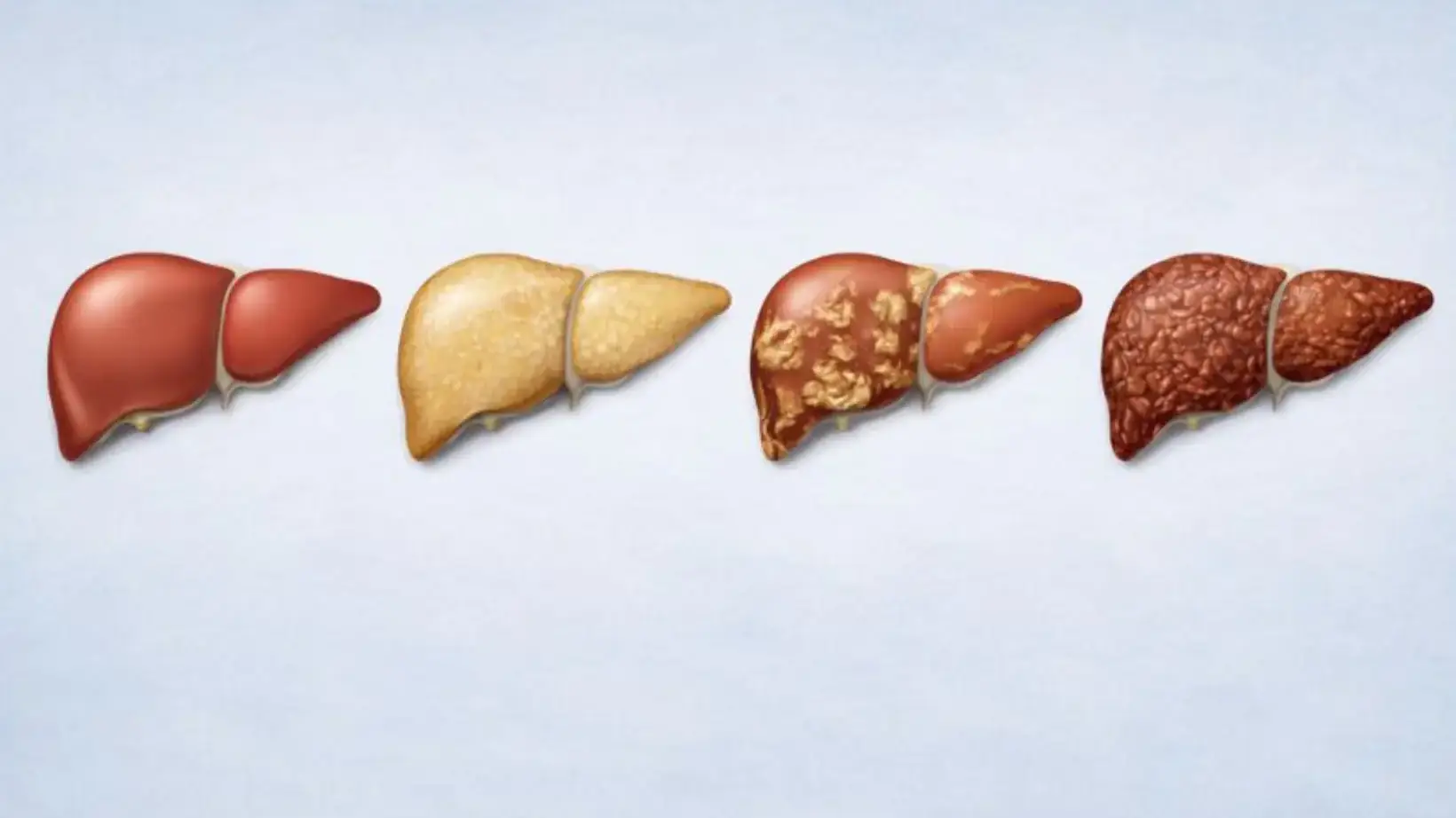 Stages of Liver Disease: Stages, Symptoms, and Treatment 15 Stages of Liver Disease