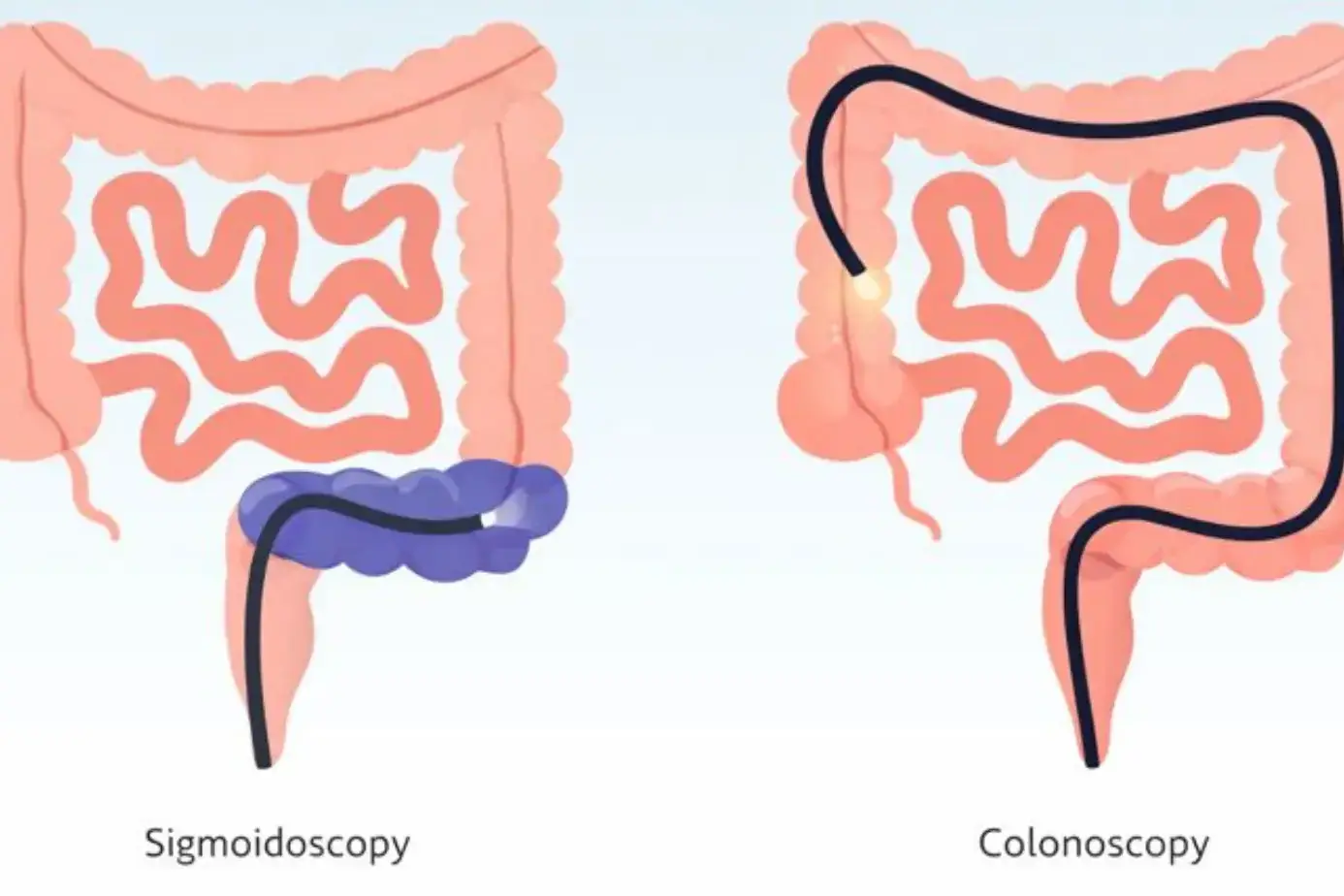 Sigmoidoscopy vs Colonoscopy: Key Differences, Uses, and Risks 4 sigmoidoscopy vs colonoscopy