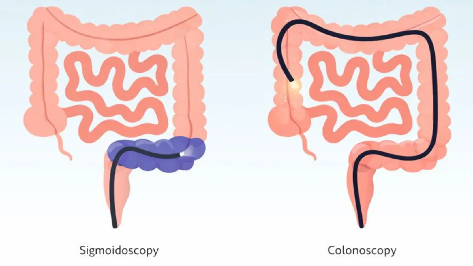 sigmoidoscopy vs colonoscopy