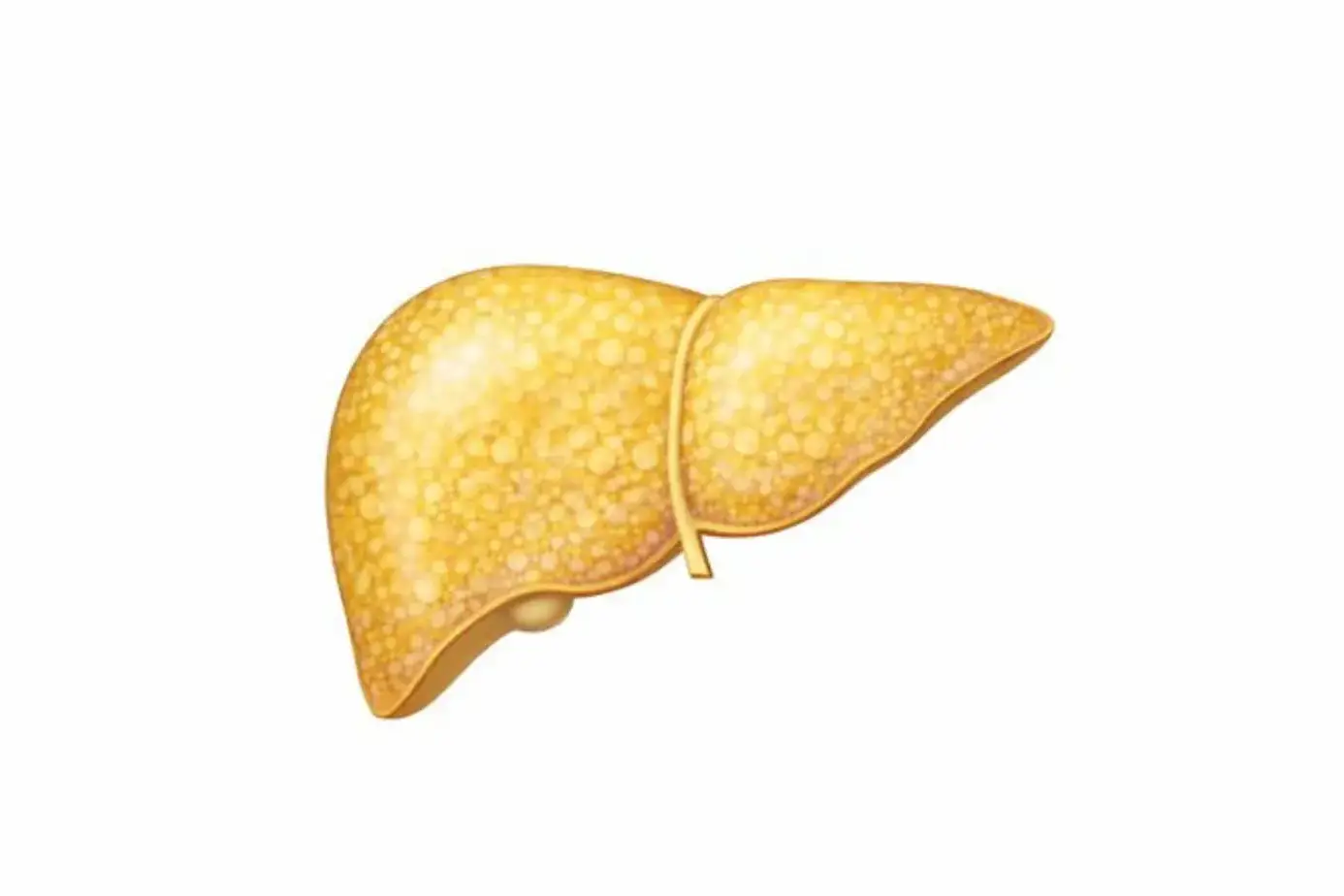 Diffuse hepatic steatosis