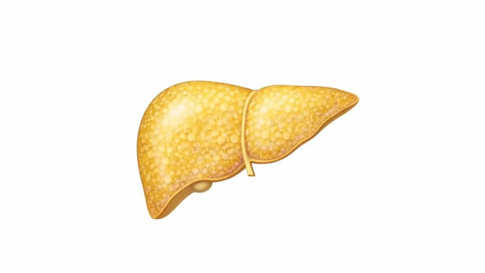 Diffuse hepatic steatosis