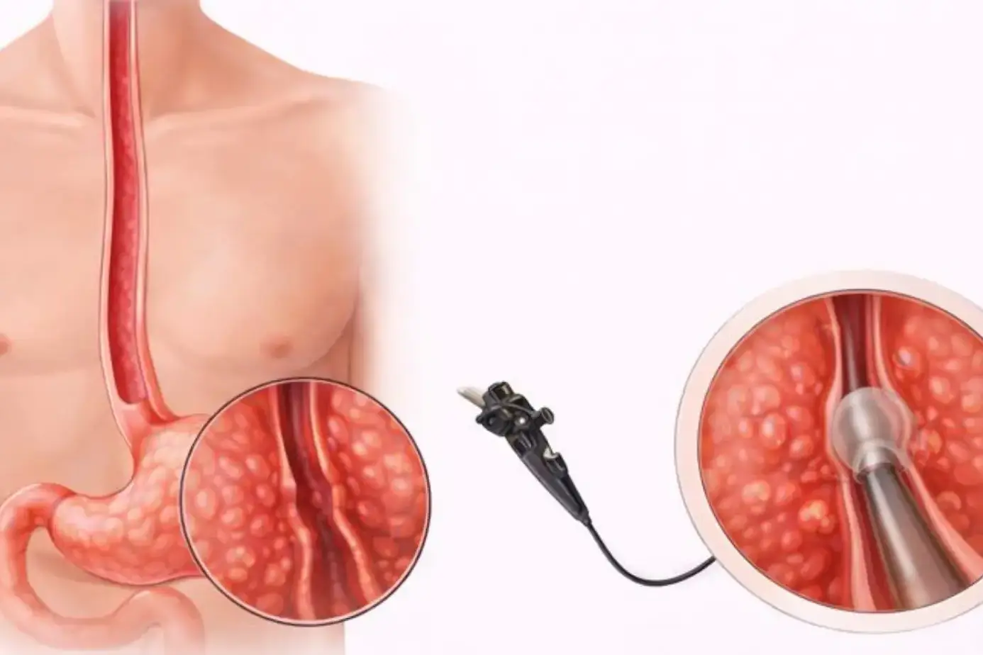 esophagitis treatments