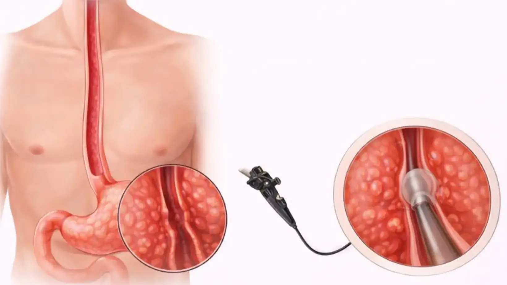 esophagitis treatments