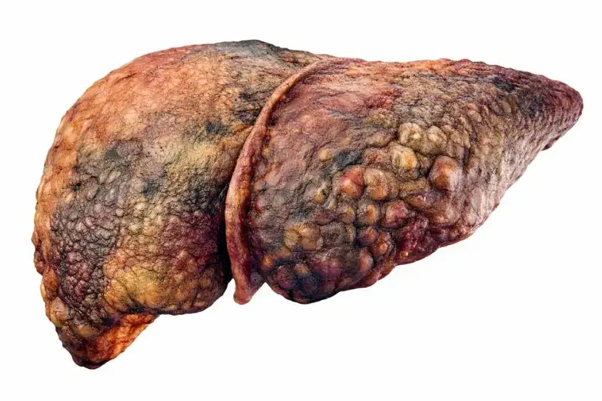 End Stage Liver Disease Symptoms: What to Expect 8 end stage liver disease symptoms