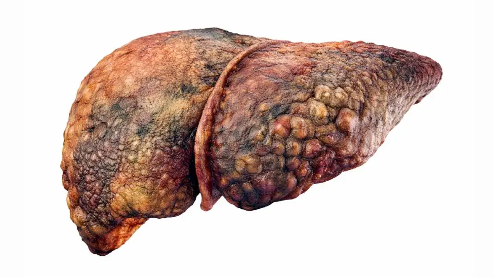 end stage liver disease symptoms​