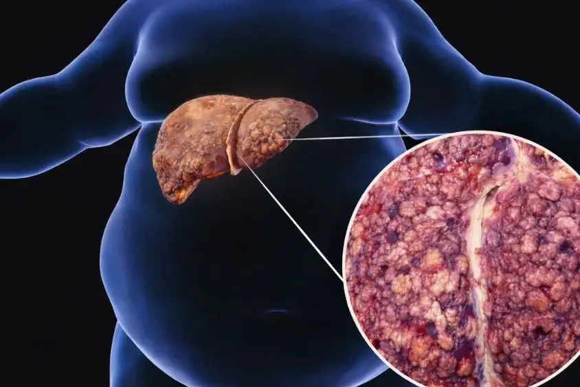 NAFLD Cirrhosis of the Liver: Causes, Symptoms, and Treatment 10 nafld cirrhosis of the liver