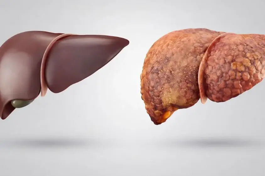 Nonalcoholic Fatty Liver Disease (NAFLD): Stages, Symptoms, and Treatment 5 nonalcoholic-fatty-liver-disease