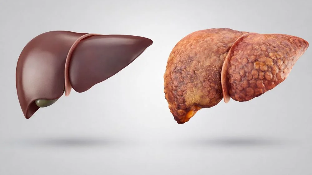 nonalcoholic-fatty-liver-disease