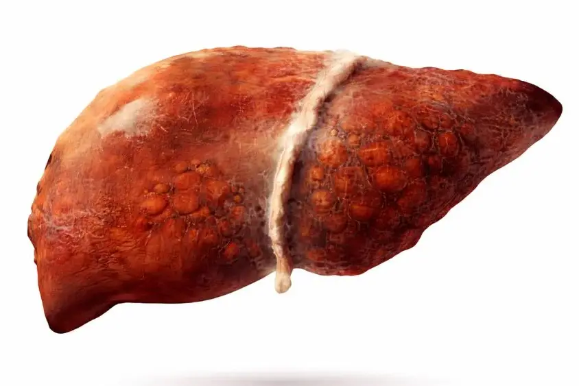 what is mash liver disease