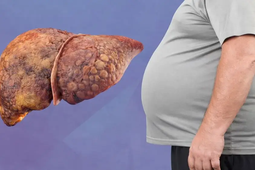 what is masld liver disease