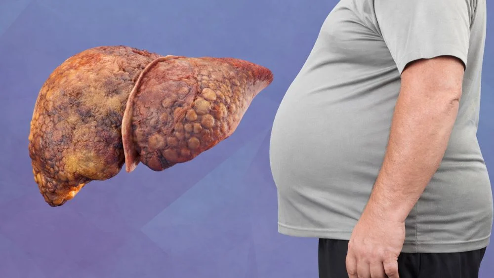 What Is MASLD Liver Disease? Meaning, Causes, and Treatment 5 what is masld liver disease