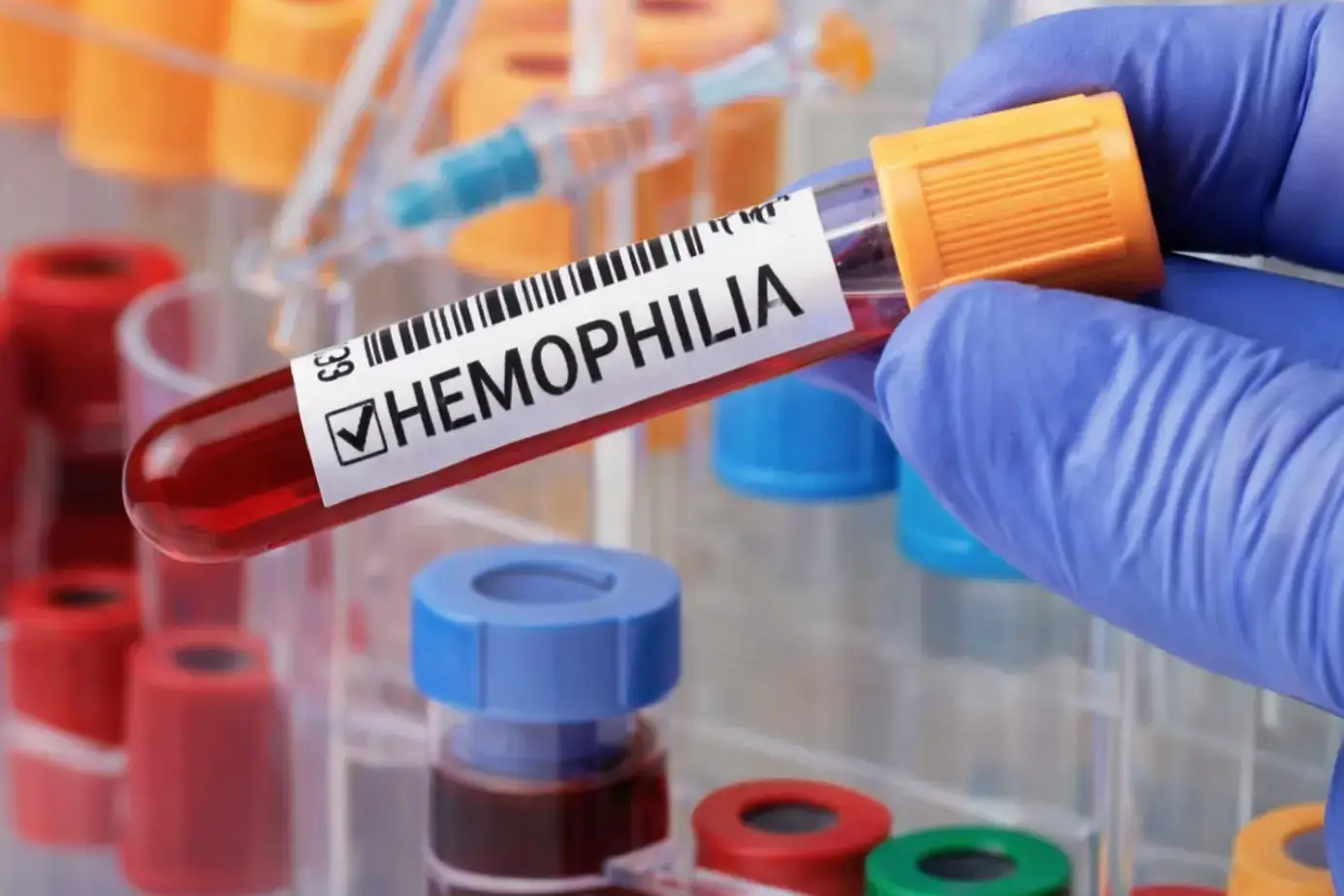 Hemochromatosis Treatment: How to Manage Iron Overload Effectively 4 Hemochromatosis treatment