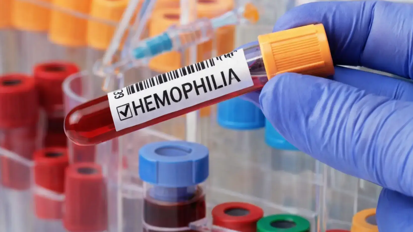 Hemochromatosis Treatment: How to Manage Iron Overload Effectively 5 Hemochromatosis treatment