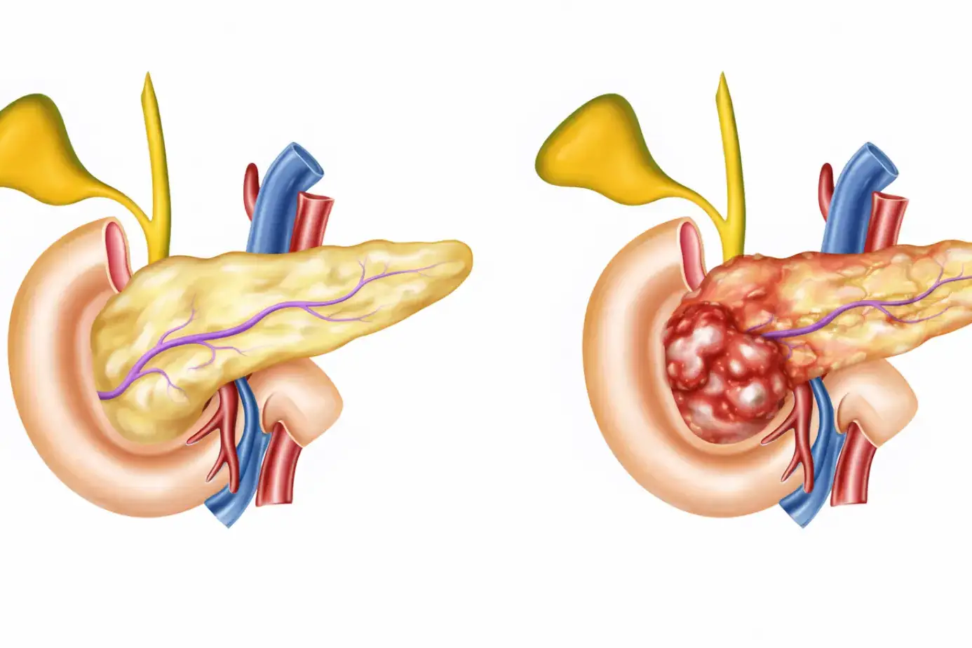 chronic pancreatitis life expectancy