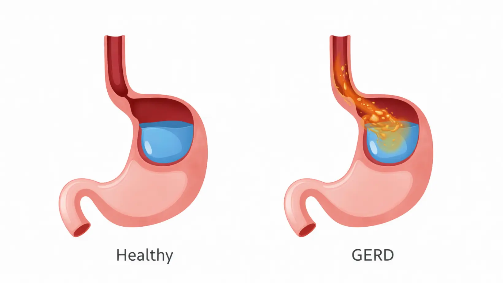 Difference Between GERD and Acid Reflux: Symptoms, Causes, and Treatment 6 difference between gerd and acid reflux