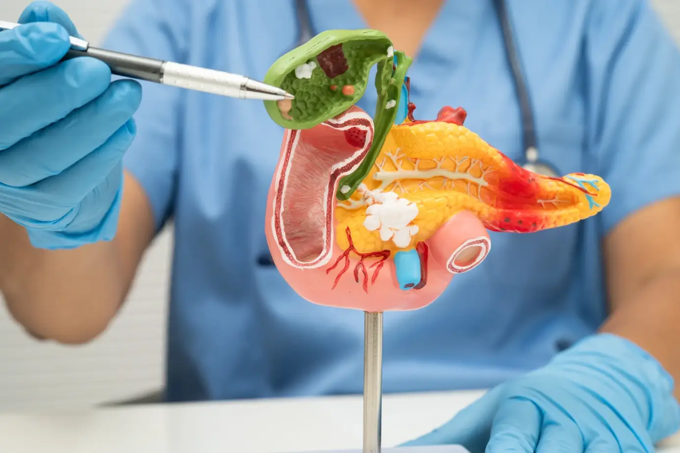 symptoms of gallstones​