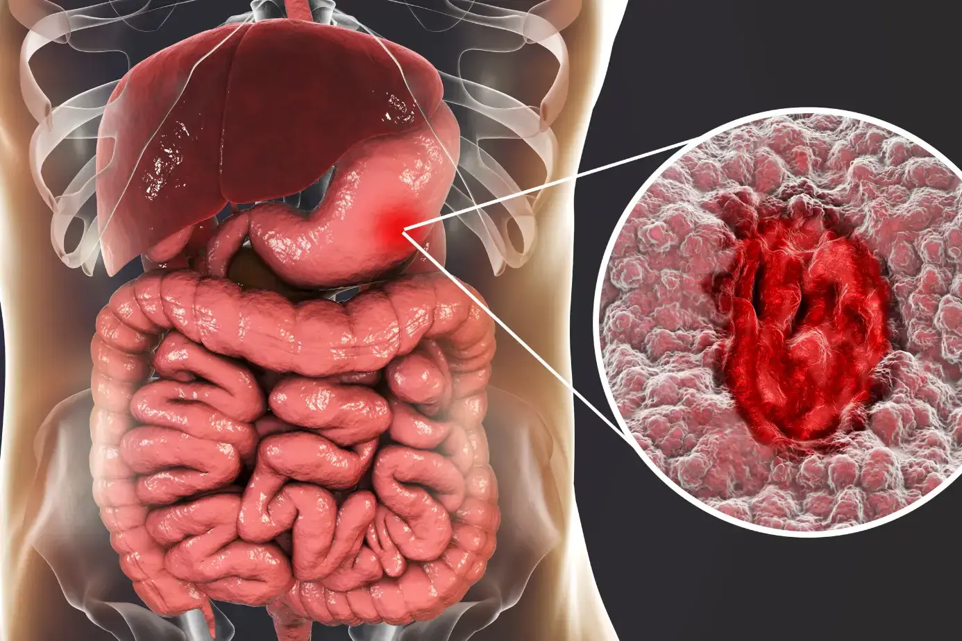 Differences Between Gastric and Duodenal Ulcers: Symptoms, Causes, and Treatment 27 Differences between gastric and duodenal ulcers