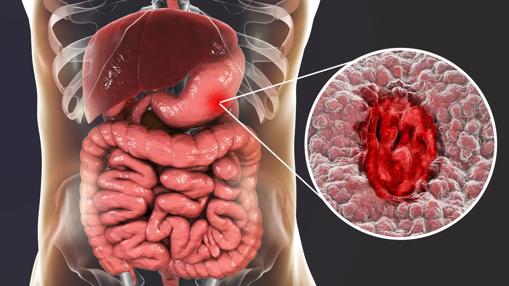 Differences Between Gastric and Duodenal Ulcers: Symptoms, Causes, and Treatment 2 Differences between gastric and duodenal ulcers