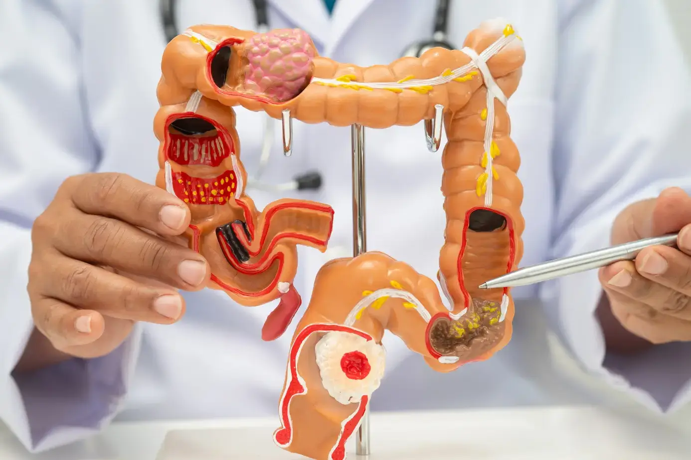 Colon Cancer Symptoms: Early Warning Signs, Causes, and When to Get Screened 26 colon cancer symptoms