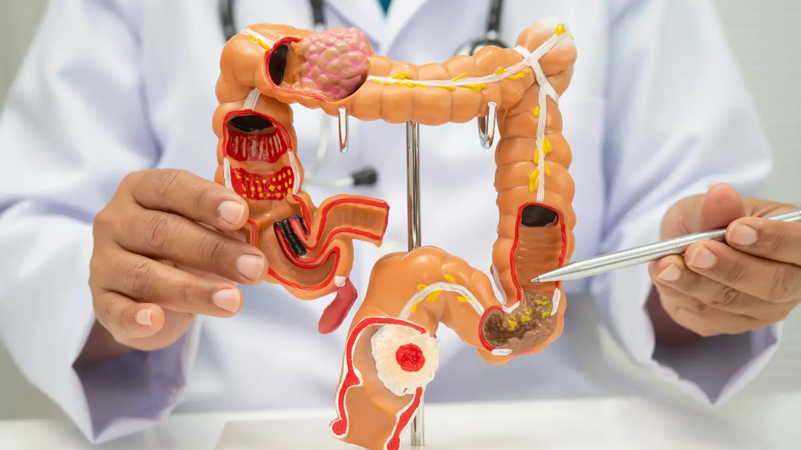 Colon Cancer Symptoms: Early Warning Signs, Causes, and When to Get Screened 9 colon cancer symptoms